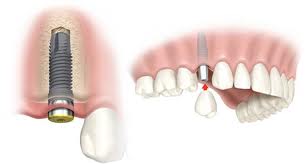 стоматология имплантация зубов